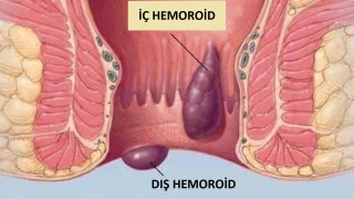 Hemoroid: Sinsi �lerleyen, Kar��t�r�lan ve Geciktirilen Bir Sorun