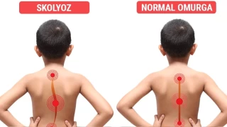 Çocuklarınızın omuzlarının hizasında fark varsa dikkat!