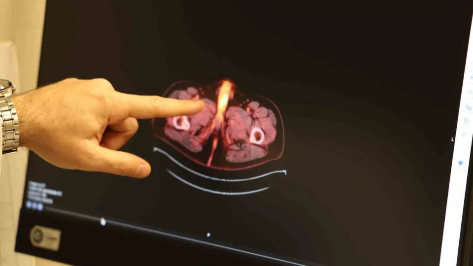 Dünyada 60 kişide olan bu vakanın 10'nu Türkiye'de