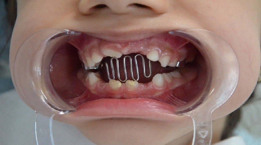 �ocu�unuzun, Parmak emme al��kanl���n� hafife almay�n