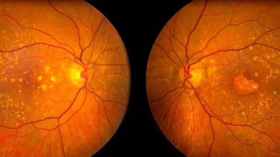 50 Yaş Üstü İçin Büyük Risk: Sarı Nokta Hastalığı