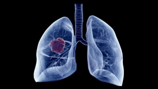 Dünyada en çok ölüme neden olan kanser akciğer kanseri