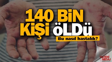 Kızamıktan 140 bin kişi öldü