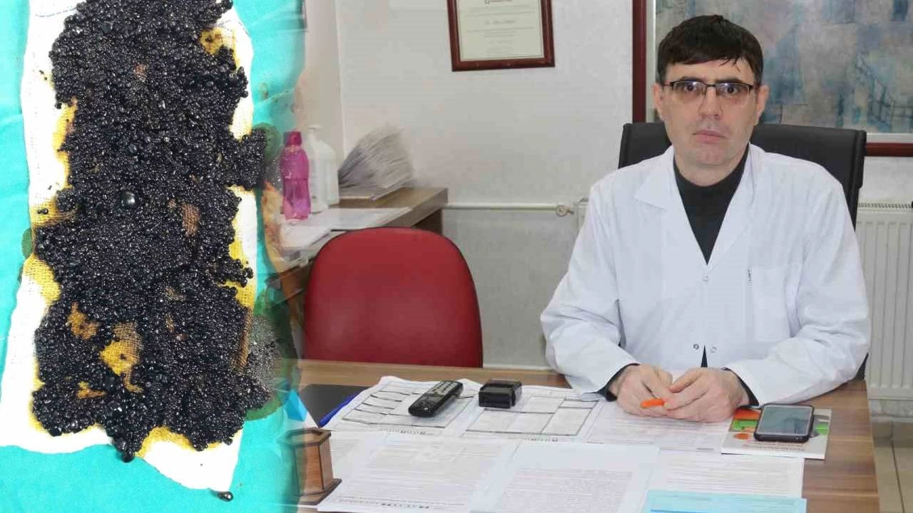 78 ya��ndaki hastan�n safra kesesinden y�zlerce ta� ��kt�