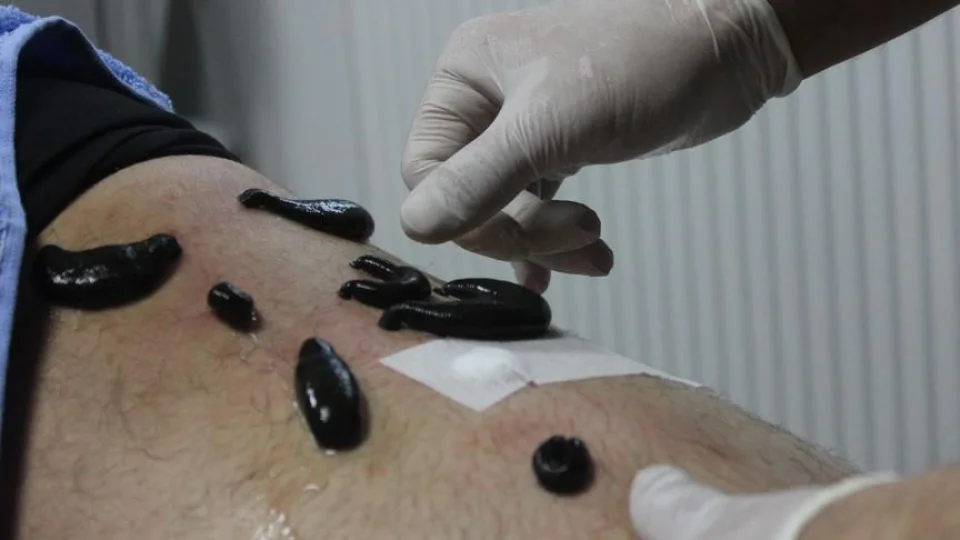 Geleneksel Tıp Gelişecek: Hacamat, Sülük ve Fitoterapi İçin Yeni Enstitü