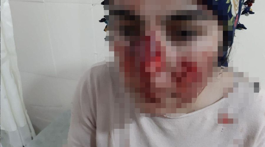 Mardin'de sokak k�pe�i vah�eti: Vatanda�lar�n y�zleri par�aland�