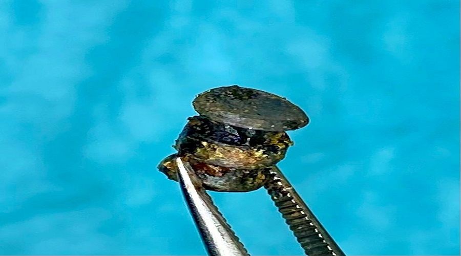 15 y�l boyunca dama��na saplanan demir par�as�n� fark etmedi