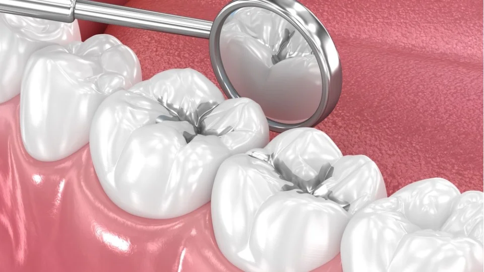 Amalgam Dolgular: Cıva Kaygısı mı, Klinik Gereklilik mi?