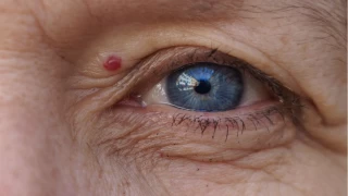 Ciltte beliren kırmızı benlere dikkat