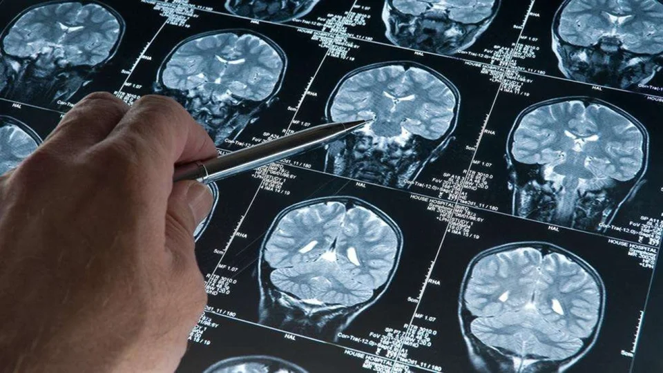 Alzheimer tedavisinde tarihi dönüm noktası