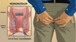 Hemoroid sand���n belirti kanser olabilir utanma ve sak�n erteleme