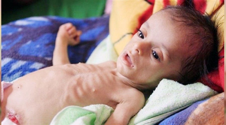 Yemen'de 10 dakikada 1 �ocuk �l�yor
