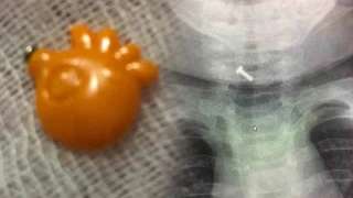9 aylık bebeğin boğazına kaçan yabancı cisim başarıyla çıkartıldı