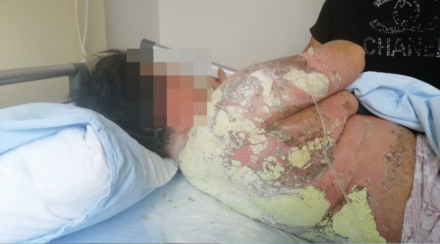 Antibiyotik bu hale getirdi   