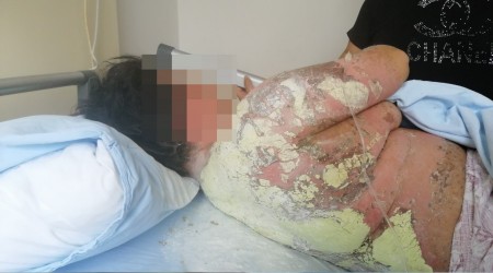 Antibiyotik bu hale getirdi   