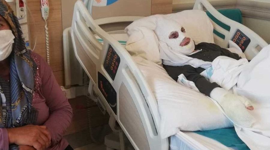 Ya�l� kad�n t�p patlamas� sonucu feci �ekilde yand�