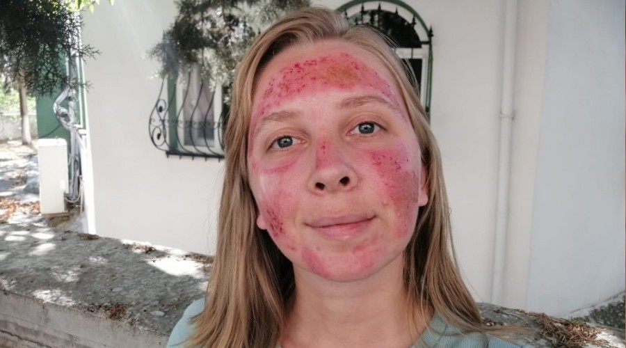 Cilt bak�m� yapt�ran kad�n�n hayat� karard�