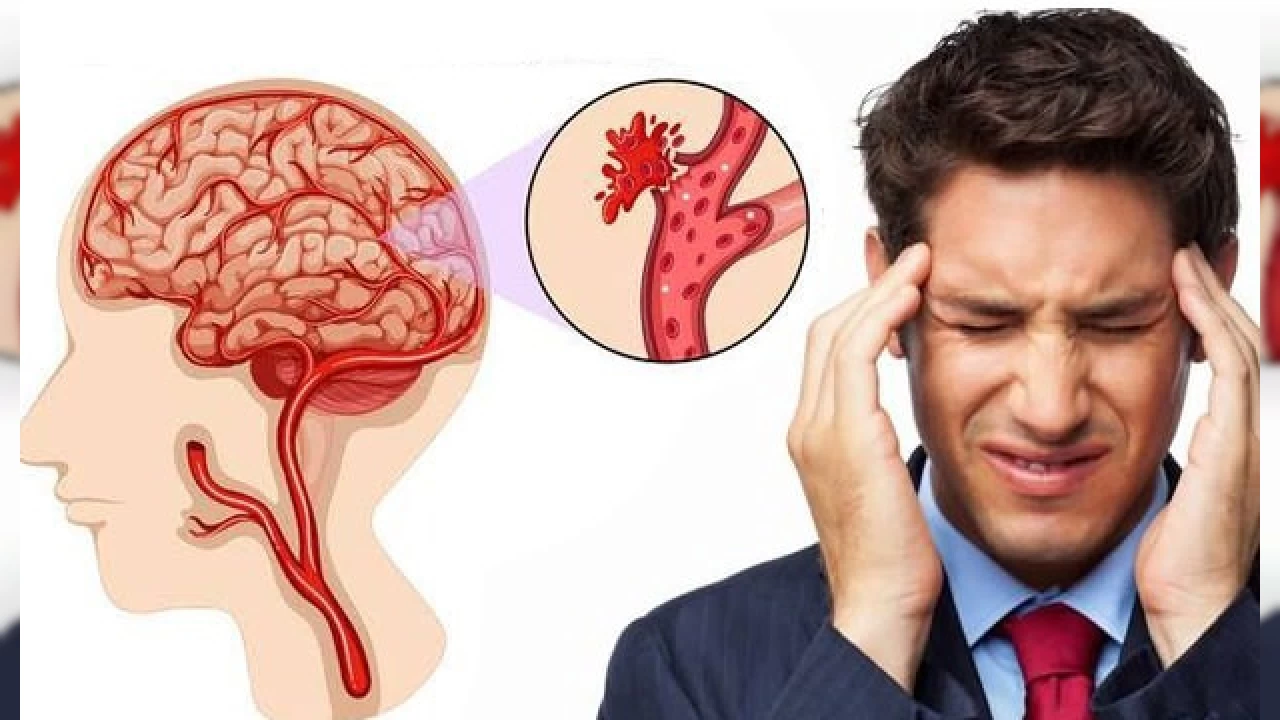 Her y�l 1 milyon ki�i beyin kanamas� ge�iriyor