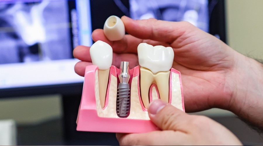 �mplantta merak edilenler