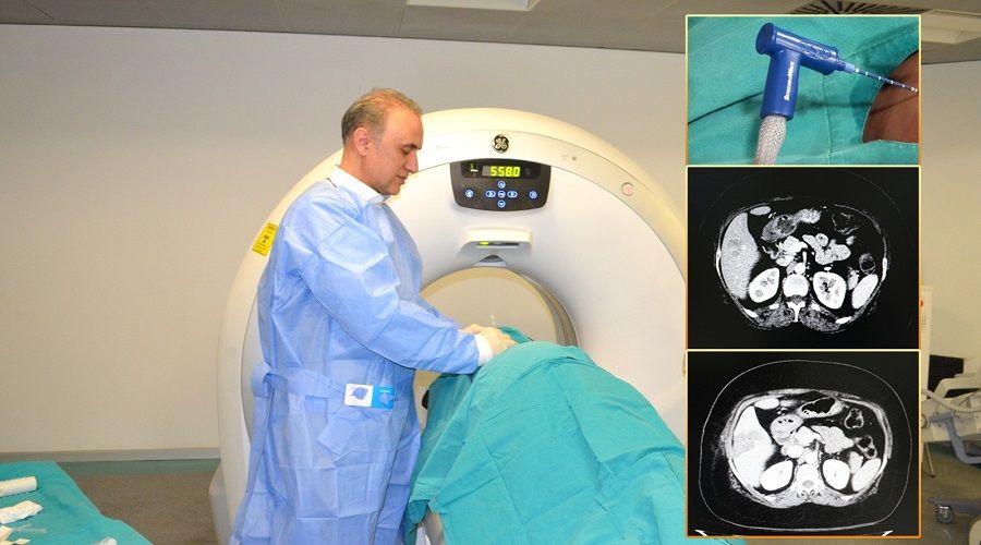 Karacier kanserinde Mikrodalga Ablasyon yntemi  