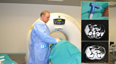 Karacier kanserinde Mikrodalga Ablasyon yntemi  