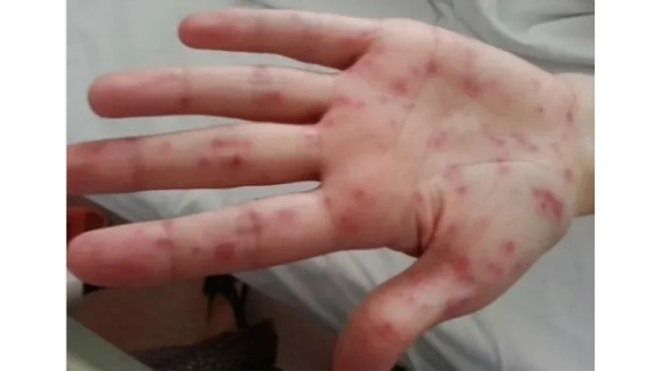  Renkler hastal�k habercisi olabilir