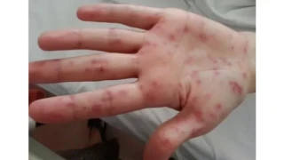  Renkler hastal�k habercisi olabilir