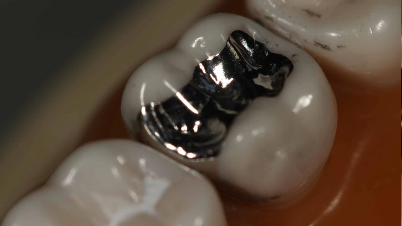 Amalgam dolgular cıva maruziyetine neden olabilir
