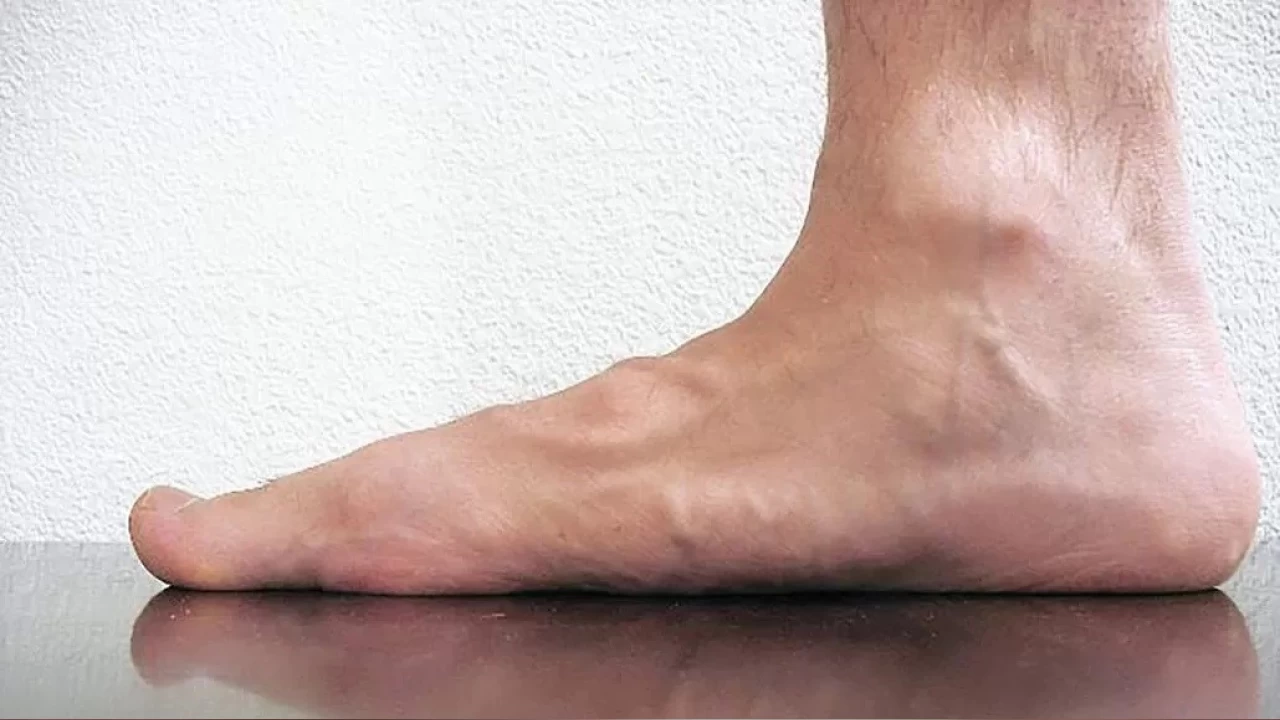 D�z taban hastal��� g�rmezden gelinmemesi gereken bir sorun