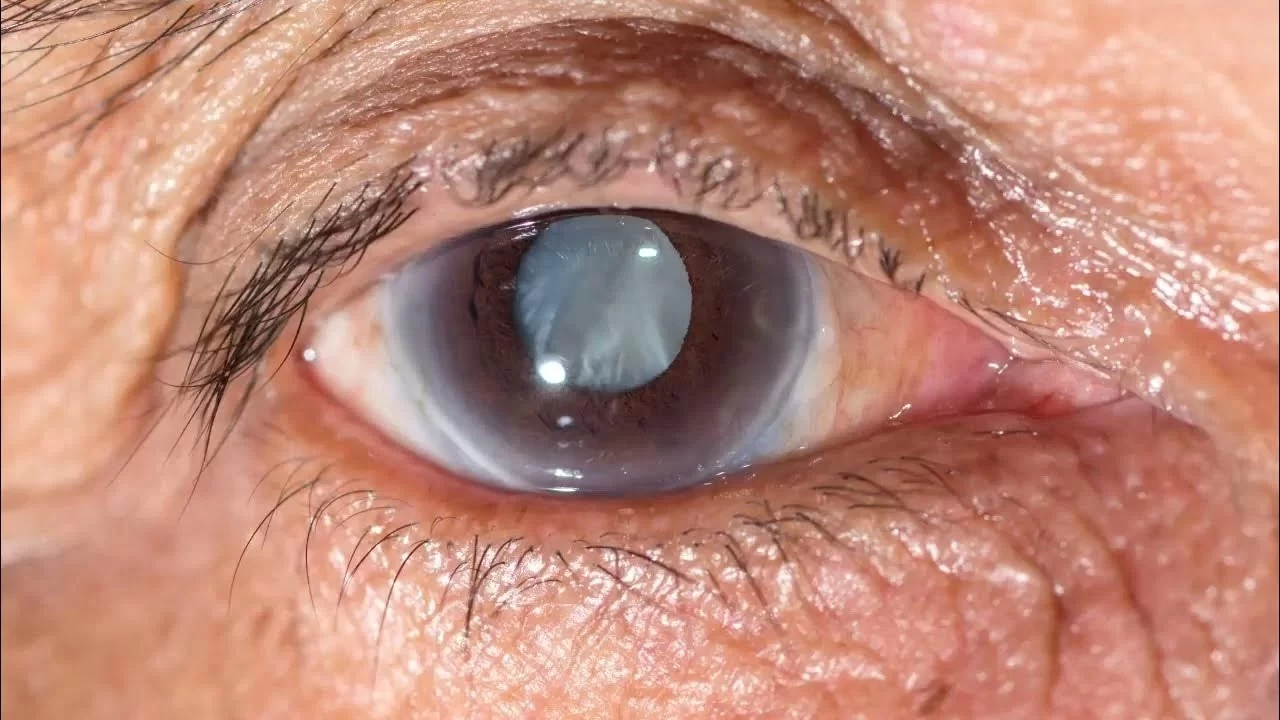 Katarakt: G�rme kayb�na yol a�an sessiz hastal�k