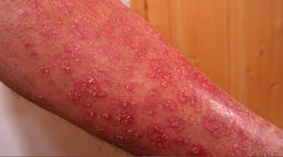 Kış aylarında vakalar artıyor
