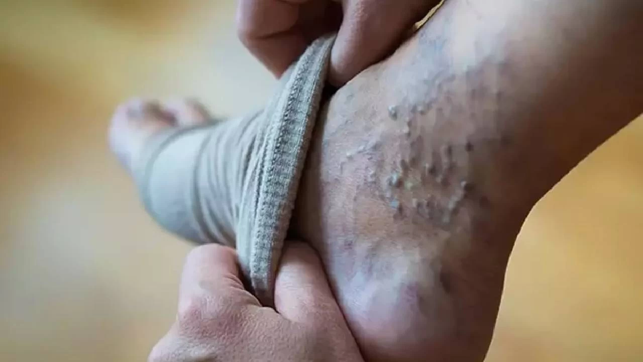 Varis şikayeti olanlara uzmanından tavsiyeler
