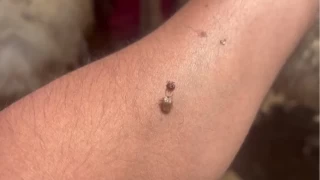 Artan kene vakalar alarm veriyor