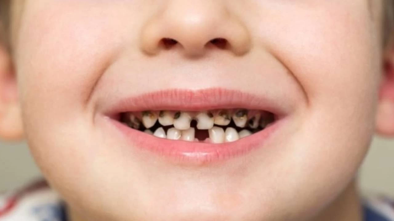 Çocuklarda diş çürümesine karşı nelere dikkat etmeli?