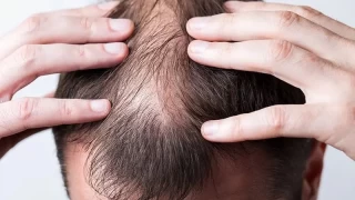 Erkeklerde saç dökülmesi kadınlara göre neden fazla görülür?