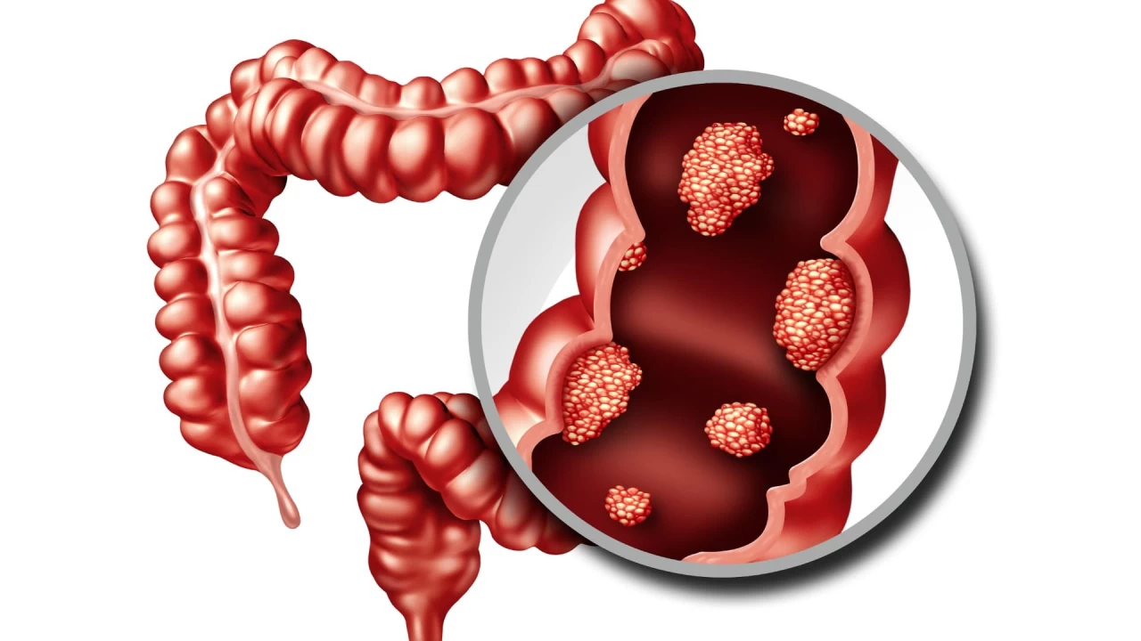 Kolorektal Kanserde Erken Te�his �ok �nemi