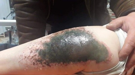 Öğrencileri 'alkali' yaktı
