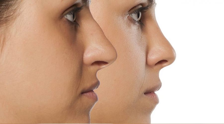 Burun ameliyat� sonras�na dikkat