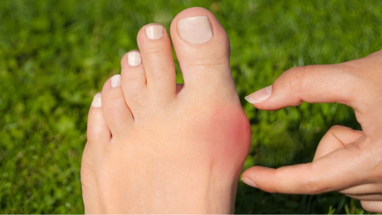 Halluks Valgus Hastalığı Hakkında Bİlinmesi Gerekenler