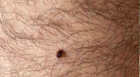 Koluna yapışan keneyi dikiş ipiyle çıkardı