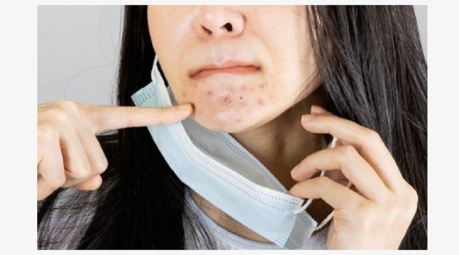Maske aknesinden kurtulma yollar�
