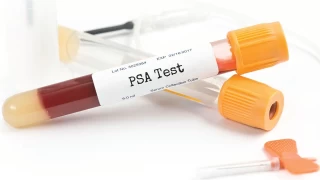 PSA testi nedir, nasl yaplr, kimler yaptrmal?