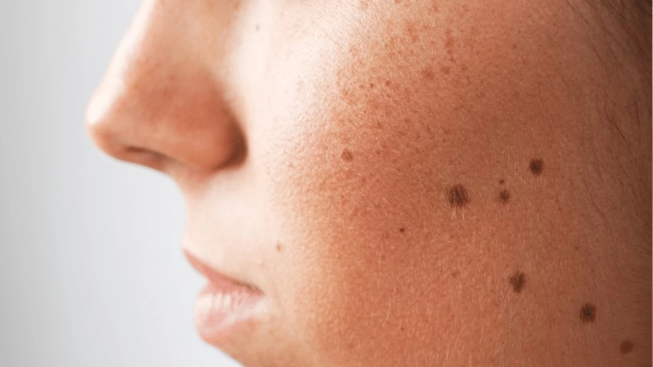 V�cuttaki baz� lekeler, t�bbi bir sorunun belirtisi olabilir