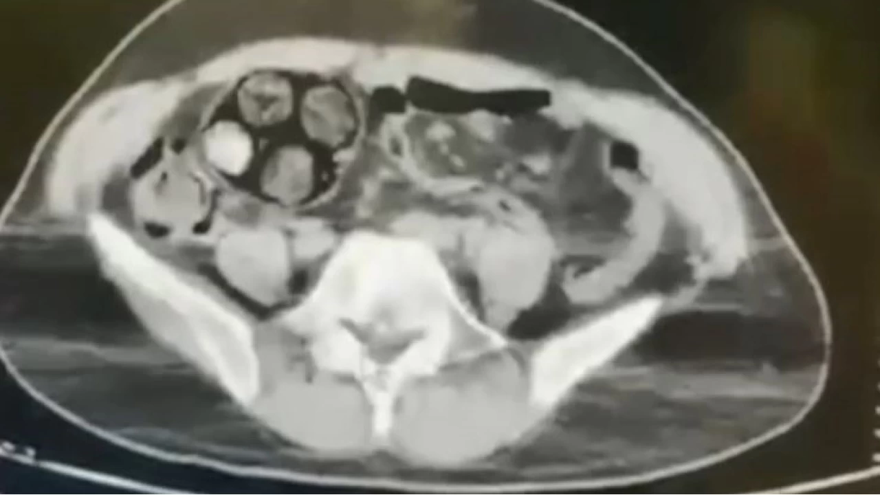 10 paket uyu�turucuyu ba��rsaklar�na saklam��