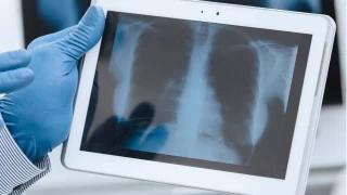 'Akciğer nodülü kanser işareti olabilir'