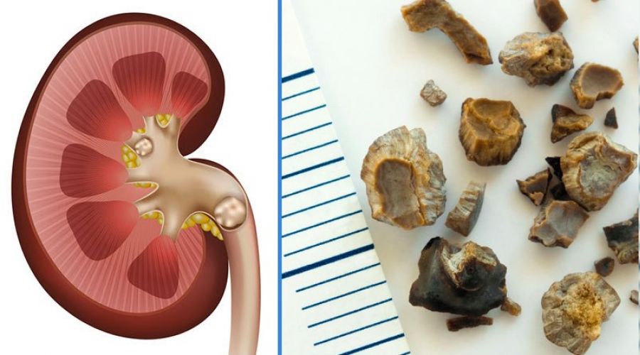 B�brek ta�lar�na dikkat