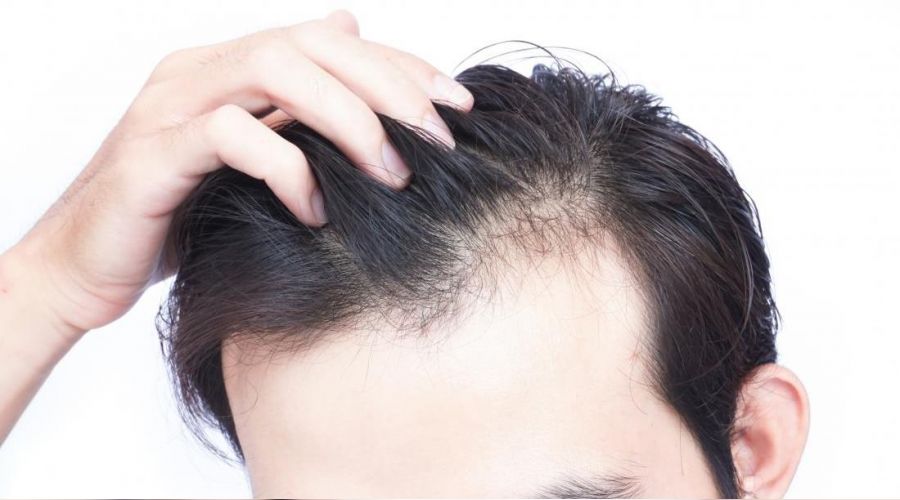 Covid’e bağlı saç dökülmesi arttı