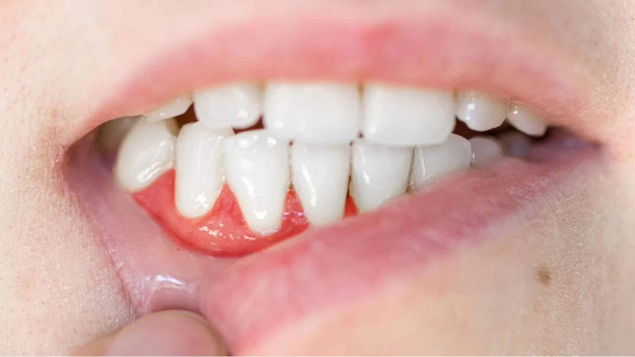 Gingivitis: A��z sa�l���n�n sessiz d��man�