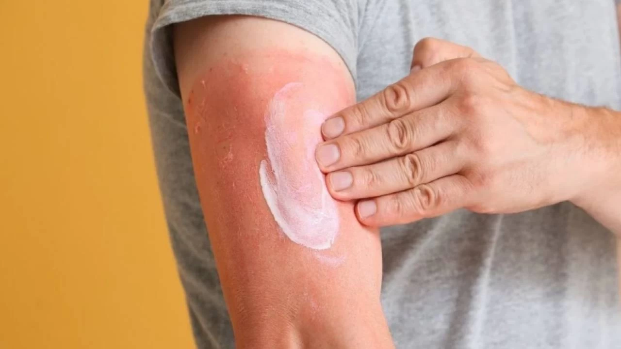 G�ne� yan���na kar�� do�al tedavi y�ntemleri