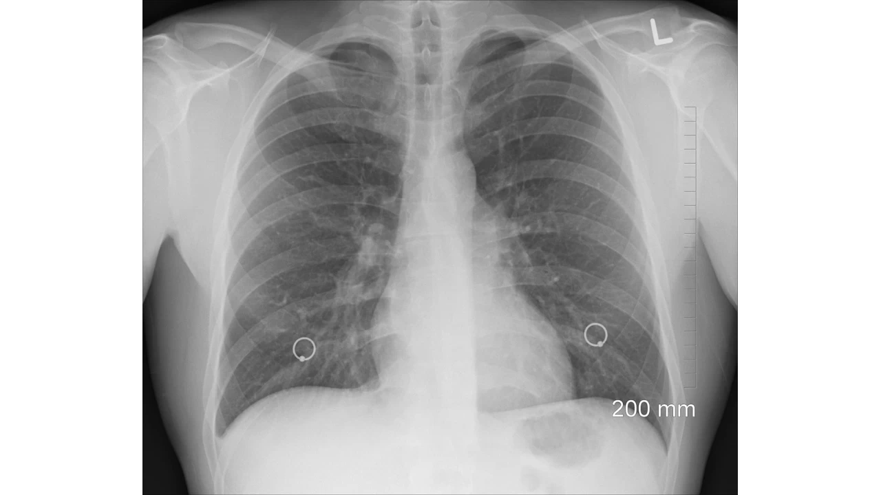 Akcier snmesi nedir?